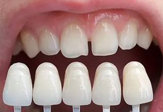 Фото 2. Несъемные зубные протезы