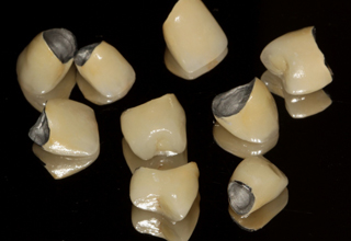 Фото 3. Несъемные зубные протезы