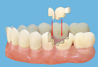 Фото 4. Несъемные зубные протезы