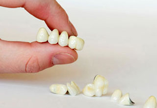 Фото 5. Несъемные зубные протезы