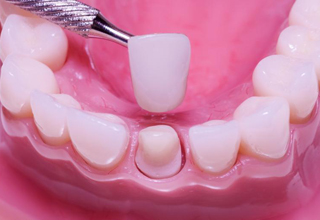 Фото 6. Несъемные зубные протезы