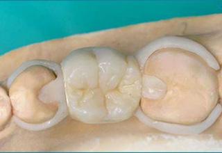 Фото 2. Cъемные зубные протезы