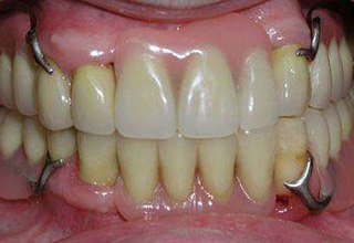 Фото 6. Cъемные зубные протезы