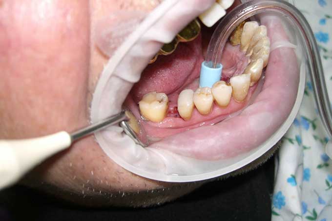операция гемисекции зуба