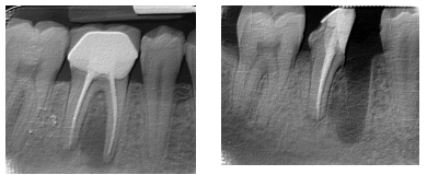 гемисекция корня зуба на рентгене 