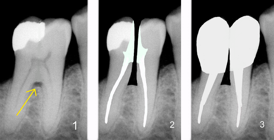 гемисекция корня зуба на схеме