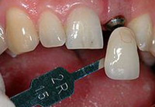 Фото 1. Имплантация передних зубов