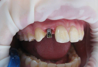 Фото 2. Имплантация передних зубов