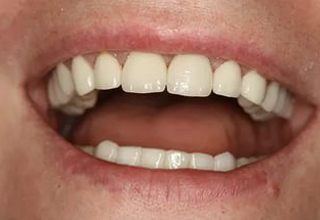 Фото 4. Имплантация передних зубов