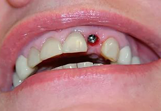 Фото 5. Имплантация передних зубов