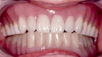 акриловый зубной протез фото 1