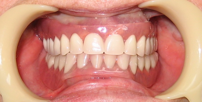акриловый зубной протез фото 7