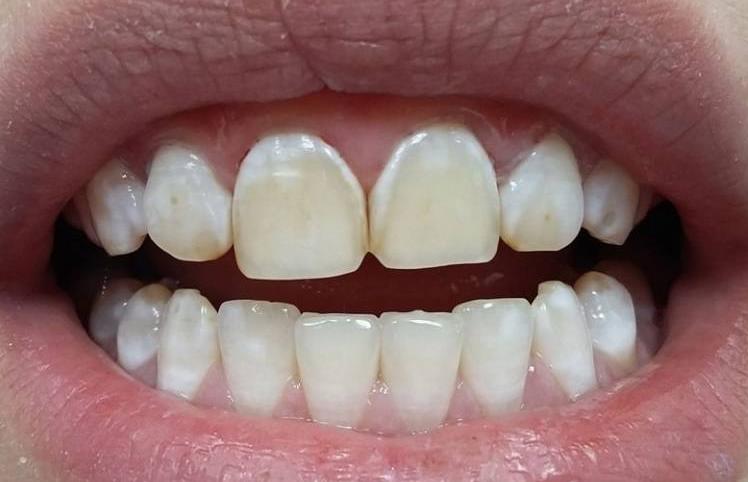 гипоплазия зубов 