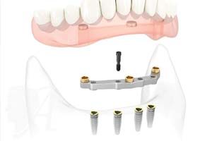 Балочное крепление зубных протезов на имплантах