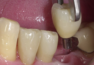 Фото 1. Импланты зубов