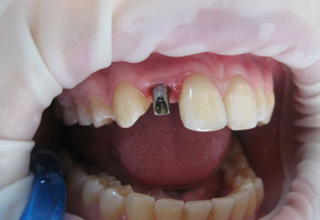 Фото 2. Импланты зубов
