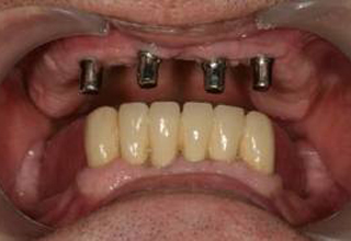 Фото 3. Импланты зубов