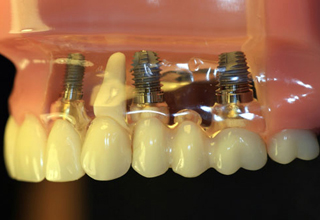Фото 4. Импланты зубов