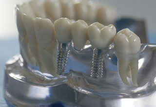 Фото 5. Импланты зубов