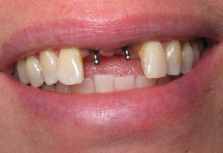 Фото 6. Импланты зубов