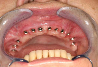 Фото 7. Импланты зубов