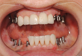 Фото 8. Импланты зубов