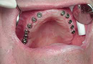 Фото 9. Импланты зубов