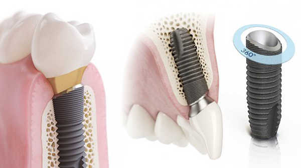 Импланты зубов astra tech