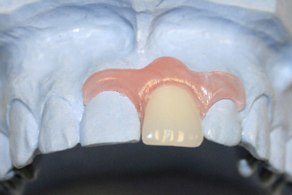 Имплантация 1 зуба протезом