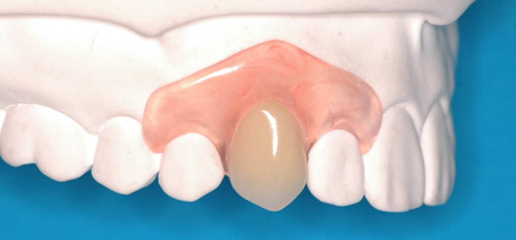 Имплантация одного зуба протезом