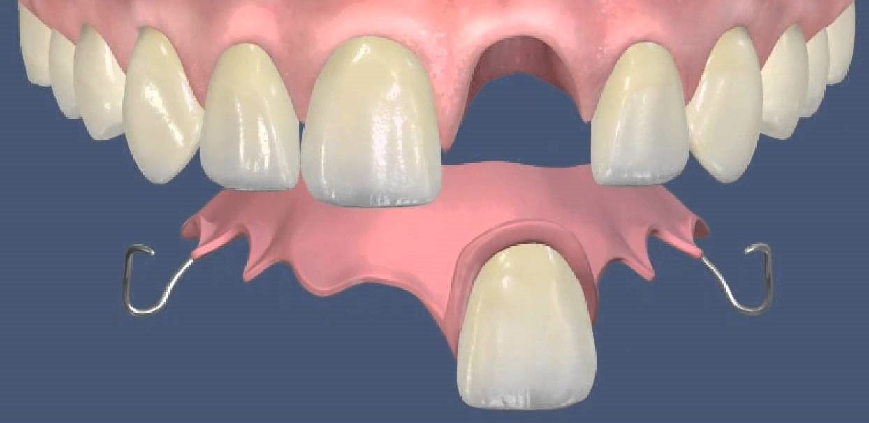 Восстановление зуба с помощью протеза