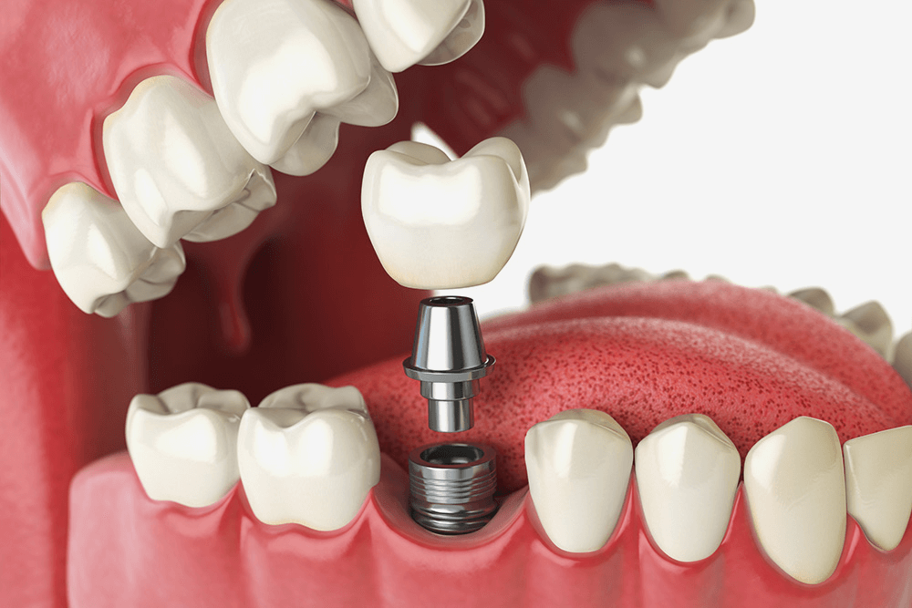 Имплантация одного зуба коронкой