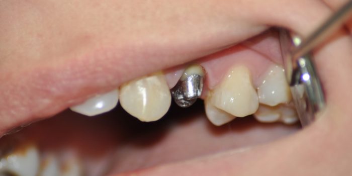 Имплантация одного зуба вкладкой