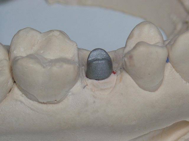 Восстановление зуба с помощью вкладки