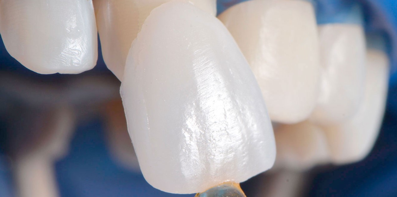 Имплантация одного зуба виниром