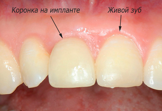 Фото 5. Импланты Xive