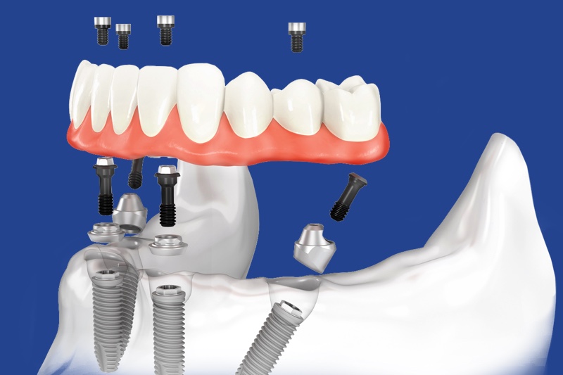 Имплантация all-on-4 для восстановления всех зубов