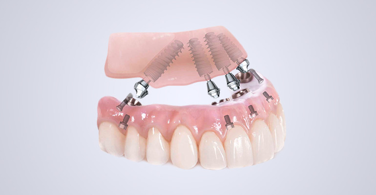 Имплантация all-on-6 для восстановления всех зубов