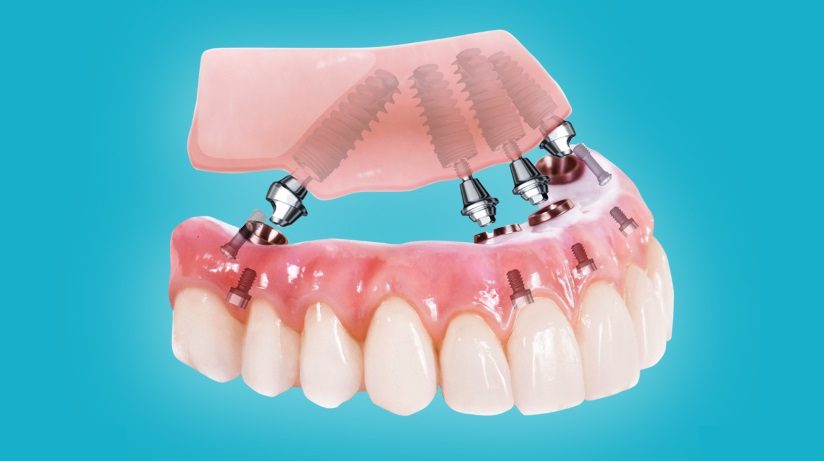 метод all-on-6 для восстановления всех зубов