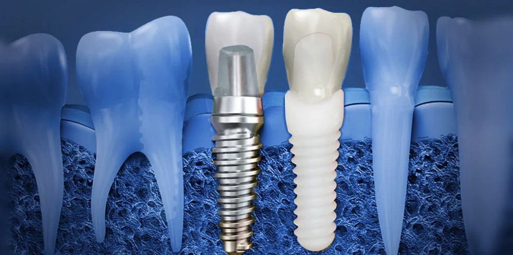 Классическая имплантация для восстановления всех зубов