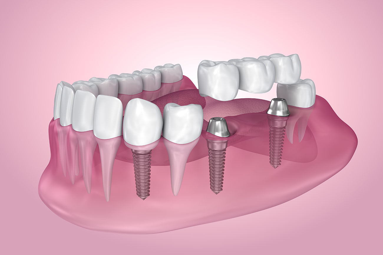 Классическая имплантация для всех зубов