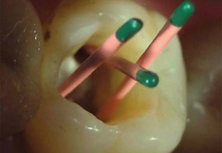 Эндодонтическое лечение в стоматологической московской клинике