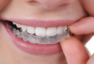 Фото 1. Выравнивание зубов без брекетов