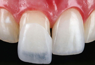 Фото 7. Выравнивание зубов без брекетов