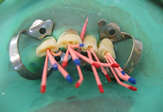 Фото 2. Лечение каналов зуба