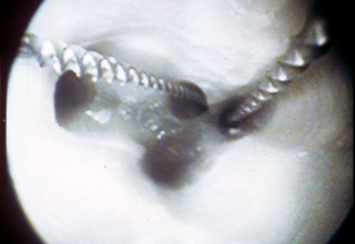 Фото 5. Лечение каналов зуба под микроскопом