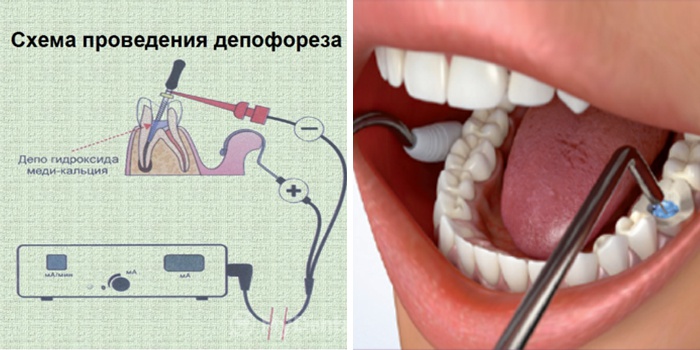 Фото депофорез корневого канала зуба – 5
