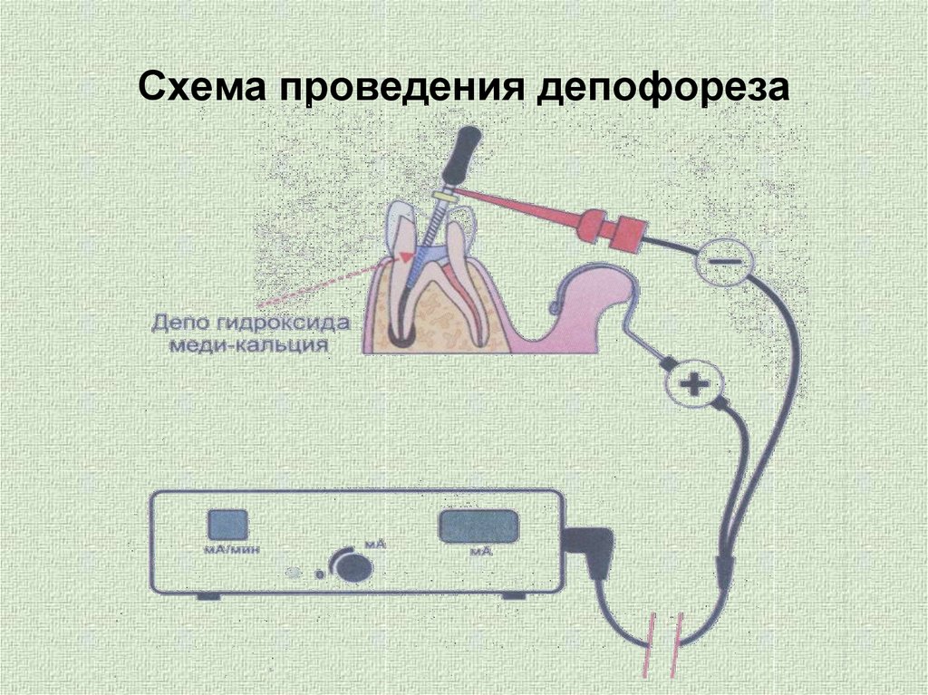Что такое депофорез в стоматологии. Смотреть фото Что такое депофорез в стоматологии. Смотреть картинку Что такое депофорез в стоматологии. Картинка про Что такое депофорез в стоматологии. Фото Что такое депофорез в стоматологии