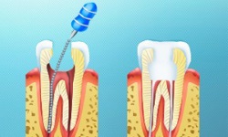 Пломбирование каналов зуба. Фото 3