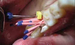 Пломбирование каналов зуба. Фото 12